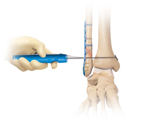 Arthrex - Syndesmosis TightRope® XP Implant System