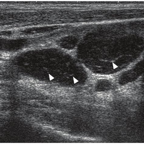 Cervical Lymph Nodes Ultrasound