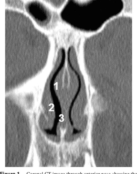 Figure 2 from Histology of the Nasal Septal Swell Body (Septal ...