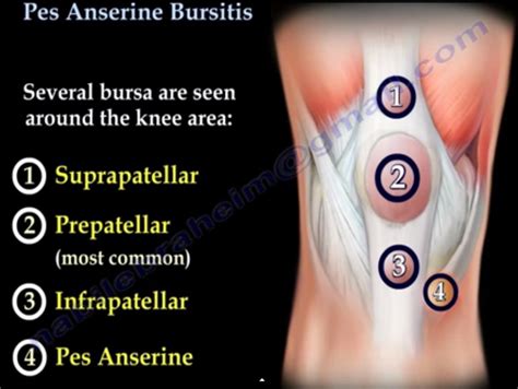 Pes Anserine Bursitis — OrthopaedicPrinciples.com