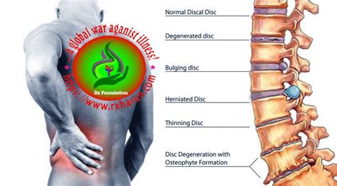 L2 and L3 Disc Herniation - Causes, Symptoms, Treatment - Rxharun