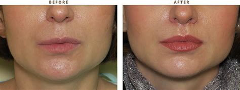 Lip Reshaping Before And After | Sitelip.org