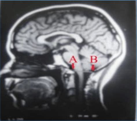 Foramen Magnum Mri