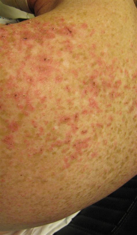 What Does A Erfly Rash Look Like - Infoupdate.org