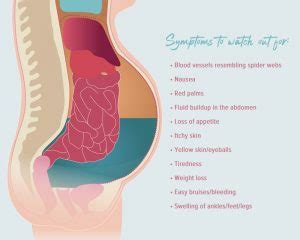 Is Liver Ascites Life Threatening? - Fatty Liver Disease