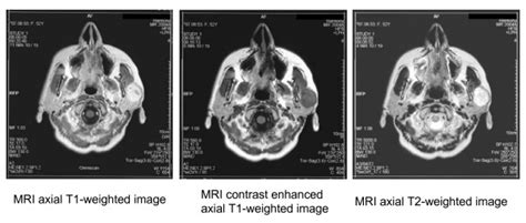 Pleomorphic Adenoma of the left parotid gland: MRI axial T1-weighted ...