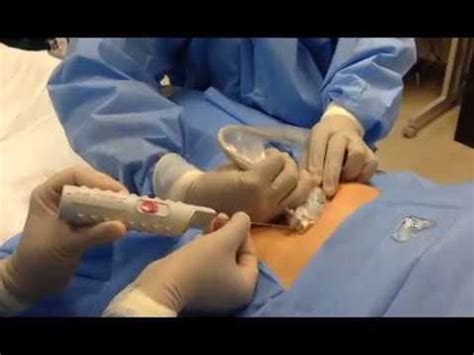 Liver Biopsy - YouTube