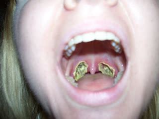 Chronicles of an Adult Tonsillectomy: Wednesday July 8, 2009 – Day of ...