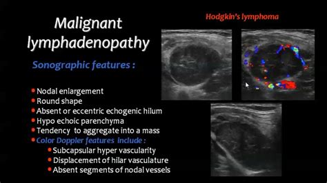 lymphoma thyroid cancer ultrasound colors - Something Serious Blogs ...