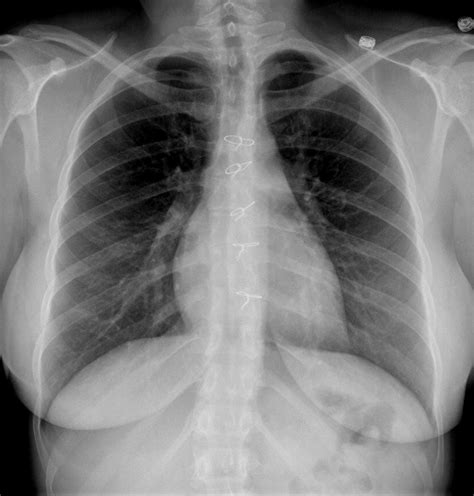 Sternal Wires - MR IMPLANT