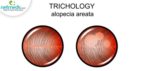 Alopecia Areata: Effective Home Remedies To Fight Unpredictable Patchy ...