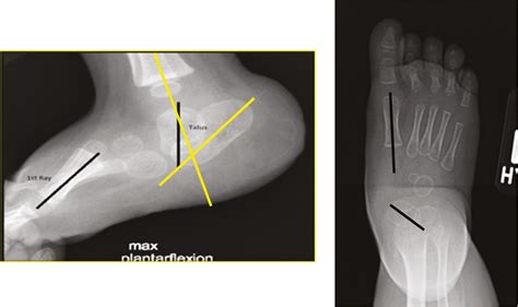 View of An Algorithmic Approach to the Congenital Vertical Talus ...