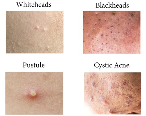 Acne: symptoms, causes and treatments