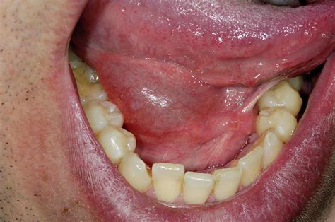 Swollen Sublingual Salivary Gland Photograph by Dr P. Marazzi/science ...