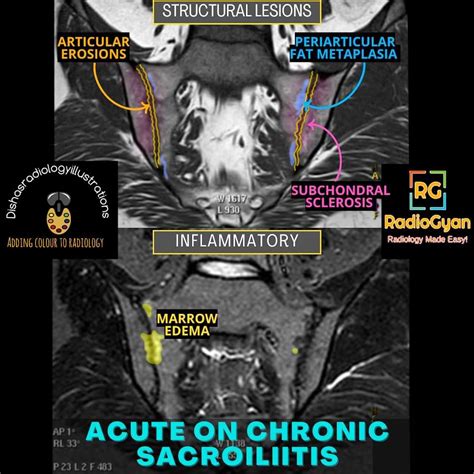 Sacroilitis | Radiology Case | - RadioGyan