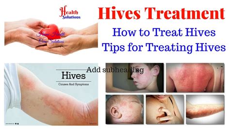 Urticaria Hives Treatment