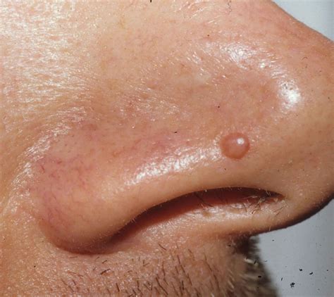 Papule or fibrous papules on nose causes, diagnosis & papule treatment