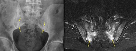 Sacroiliitis – MRI - Radiology at St. Vincent's University Hospital