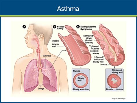 Bronchial Asthma معنى – ايميجز