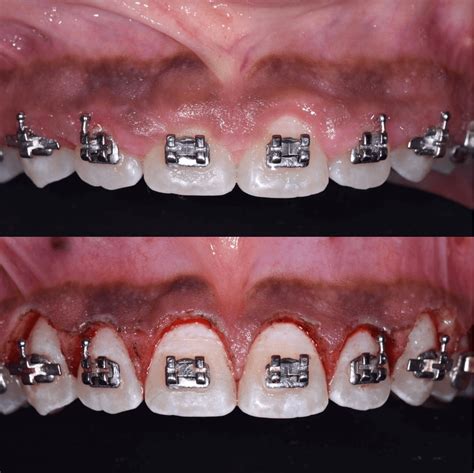 What is the difference between gingivectomy and gingivoplasty? | News ...