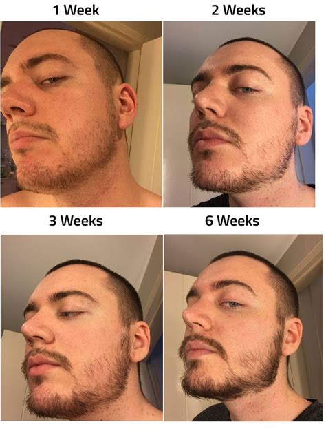 Minoxidil Before And After Beard Result - How Effective Is Minoxidil ...