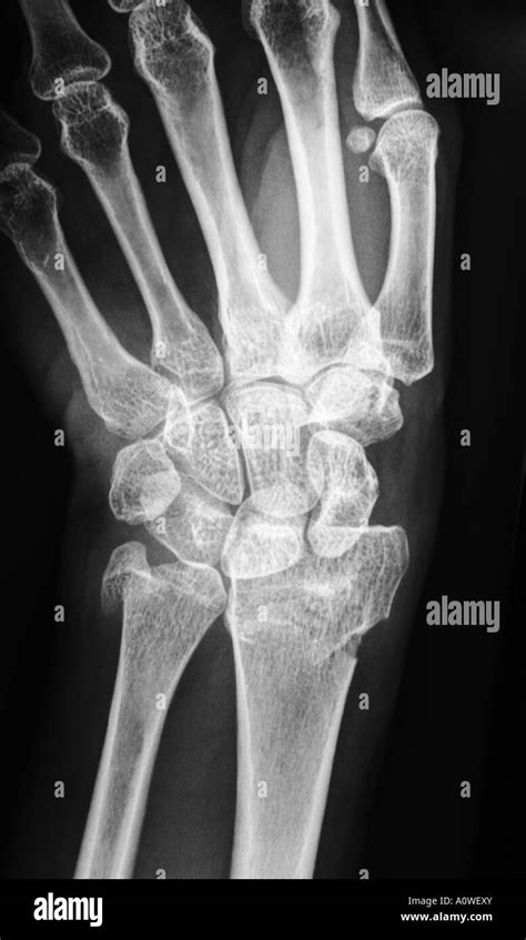 X Ray Of Human Hand With Broken Wrist Fracture Of Radius