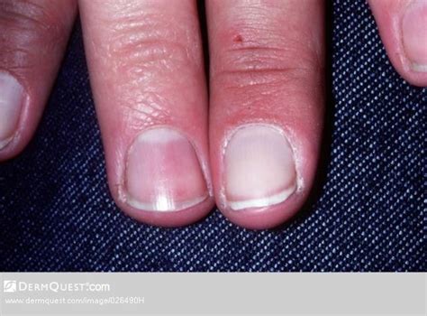 Image Library - Terry's nails | White nails, Nail psoriasis, Pink nails