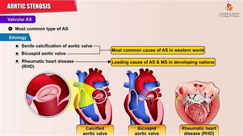 Aortic Stenosis - Causes , Symptoms , Pathology , Diagnosis and ...