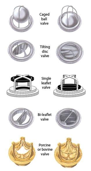 Types Of Prosthetic Heart Valves