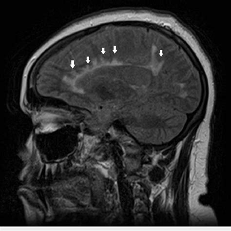 Sagittal MRI showing periventricular enhancement with radiations (white ...