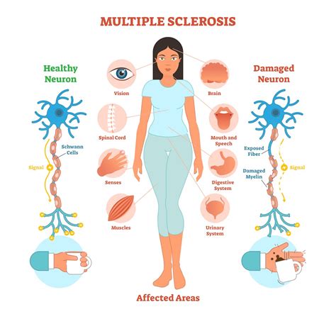 What causes multiple sclerosis? What we know, don't know and suspect