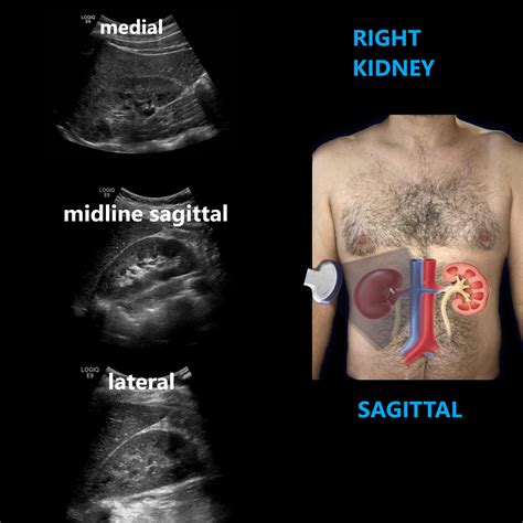 Renal Ultrasound Complete Protocol – Sonographic Tendencies