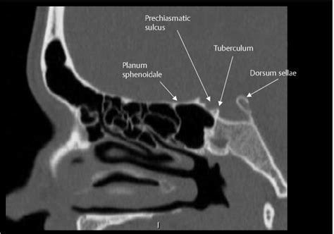 Sellar, Parasellar, and Clival Region | Radiology Key