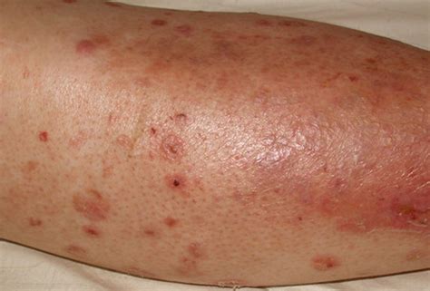 Diabetic sores on legs images | Symptoms and pictures