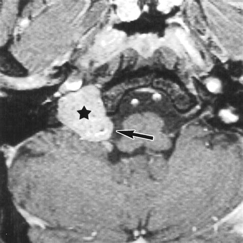 Primary Jugular Foramen Meningioma: Imaging Appearance and ...