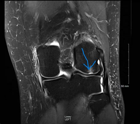 Femoral chondral defect 2: diagnosis and plan - Nell Mead