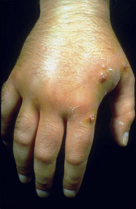 Centipede Bite: A Case Report | Dermatology | JAMA Dermatology | JAMA ...