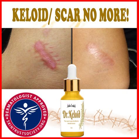 BEST QUALITY Dr. Keloid scar and keloid remover , keloid scar remover ...