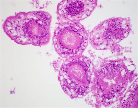 Hydatid Cyst Structure