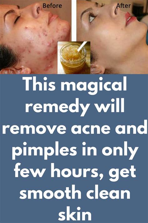 This magical remedy will remove acne and pimples in only few hours, get ...