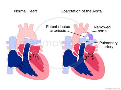 Coarctation of the Aorta – Medmovie.com