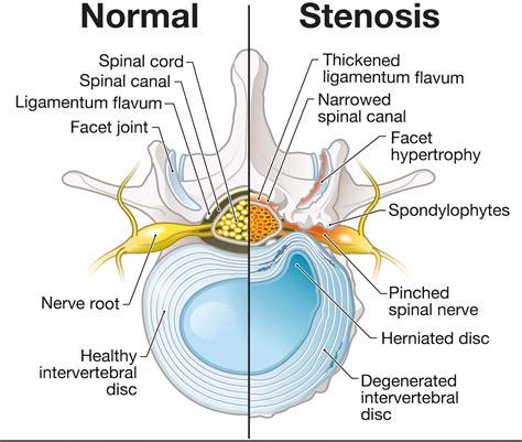 Lumbar Spinal Stenosis Diagram