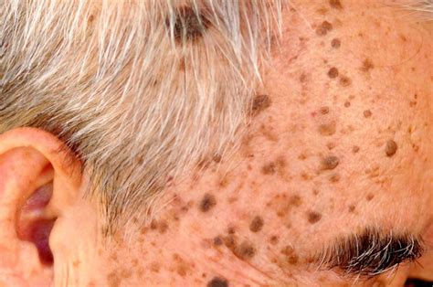 What Is Seborrheic Keratosis And Can It Be Removed?