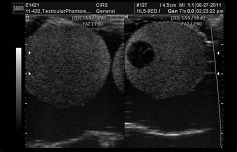 Scrotal Ultrasound | Best Urologists in Forest Hills, Queens, NY ...