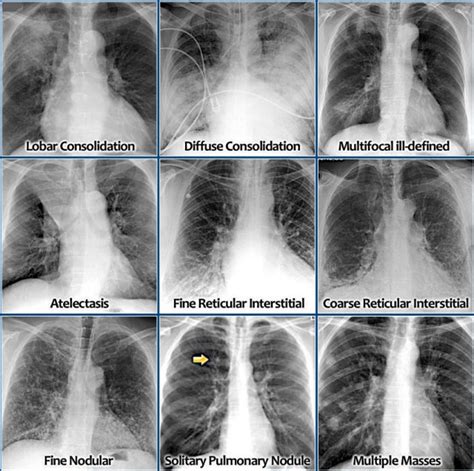 Bronchitis Lungs Xray