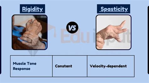 Difference Between Rigidity and Spasticity