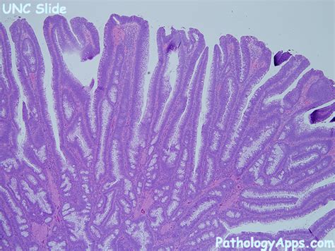 villous adenoma pathology