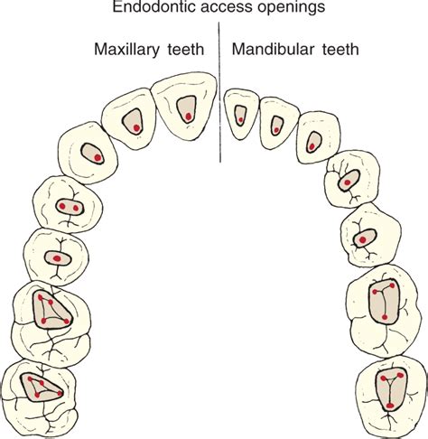 Internal pulp cavity morphology related to endodontic and restorative ...