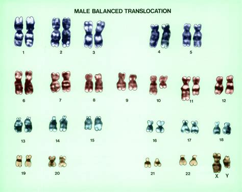 Male Balanced Translocation Karyotype Photograph by Biophoto Associates