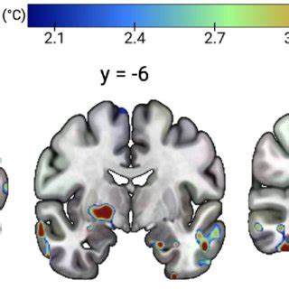 Regions where patients with functional seizures (FS) had higher mean ...